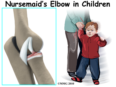 Nursemaid's Elbow