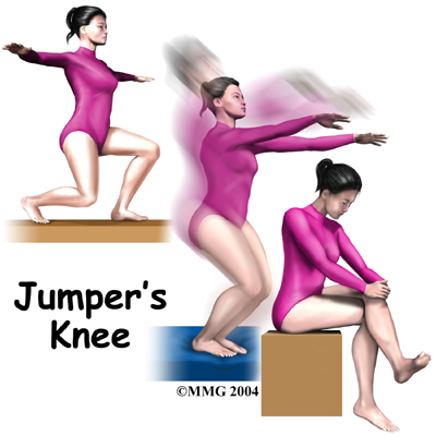 Jumpers Knee in Children and Adolescents